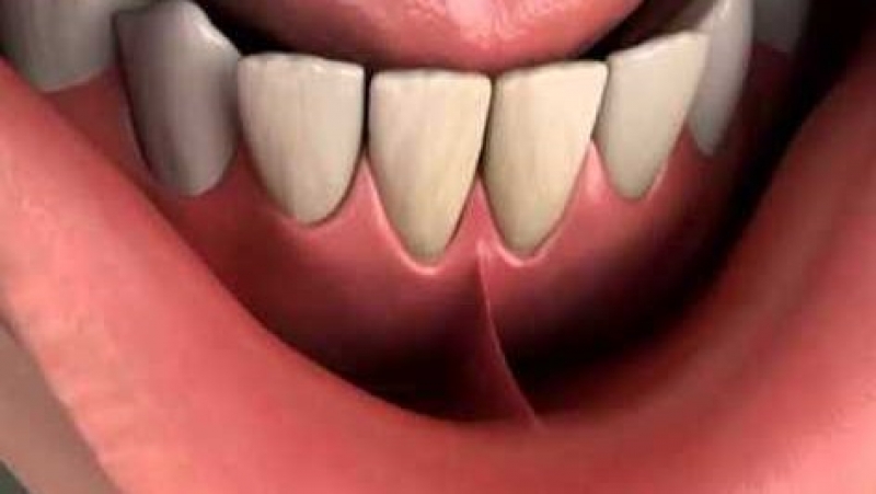 La frenulectomia del Centro Odontoiatrico Pitino