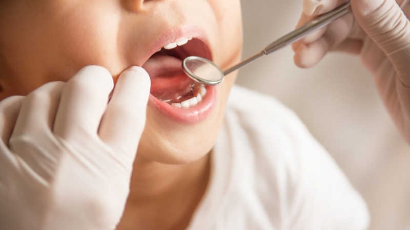 La sigillatura dei denti del Centro Odontoiatrico Pitino