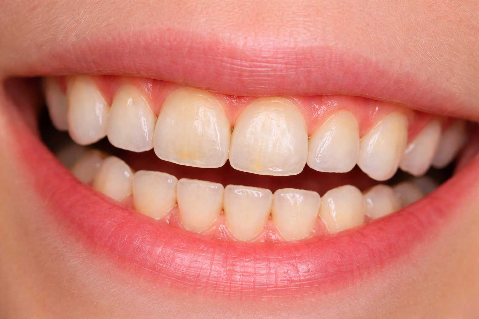 segni di usura dentale associati al bruxismo notturno nel bambino