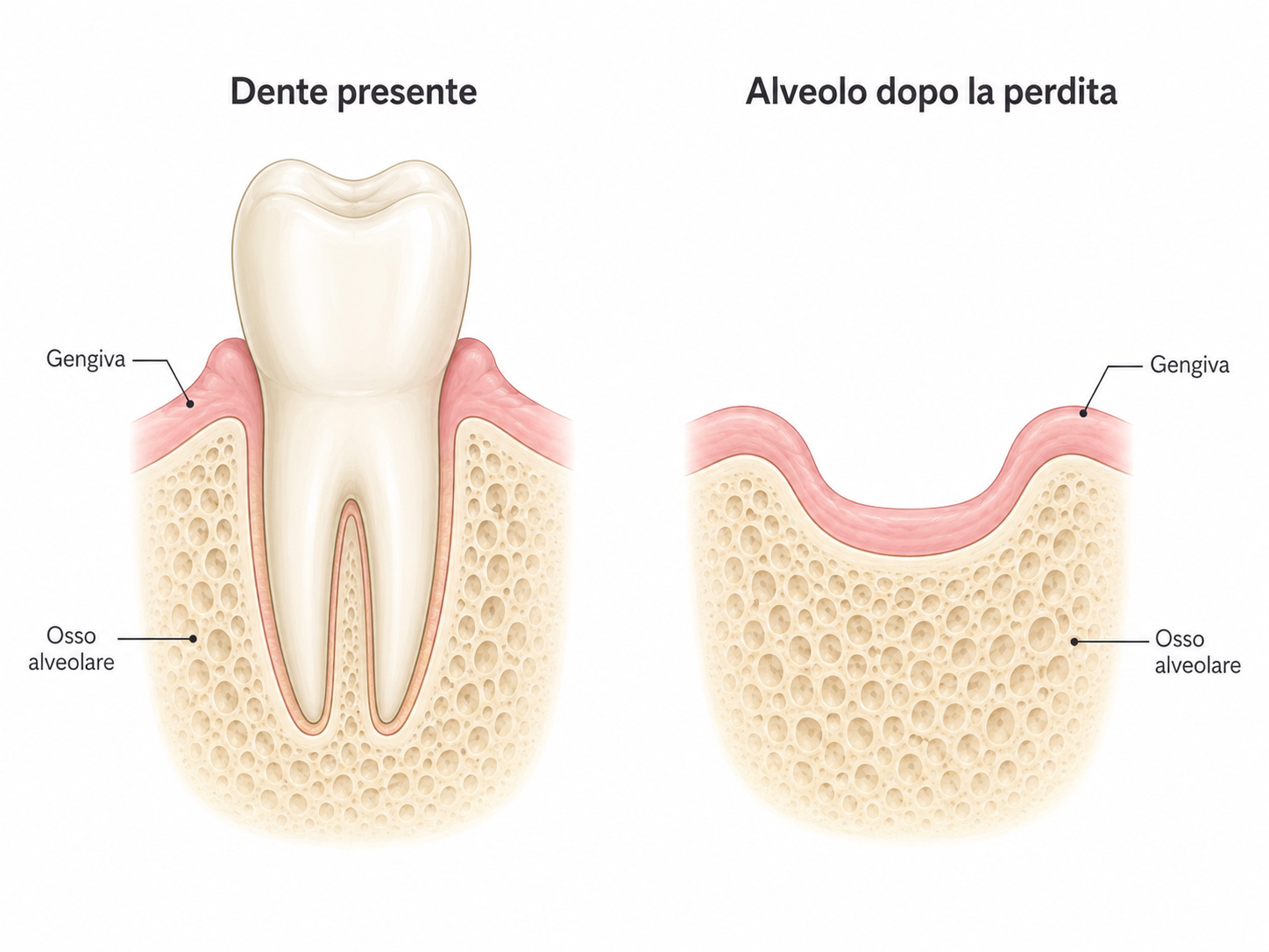 Riassorbimento dell’osso alveolare dopo la perdita di un dente