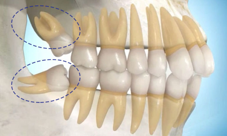 Estrarre il dente del giudizio al Centro Odontoiatrico Pitino