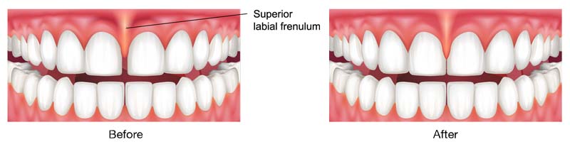 La frenulectomia linguale del Centro Odontoiatrico Pitino