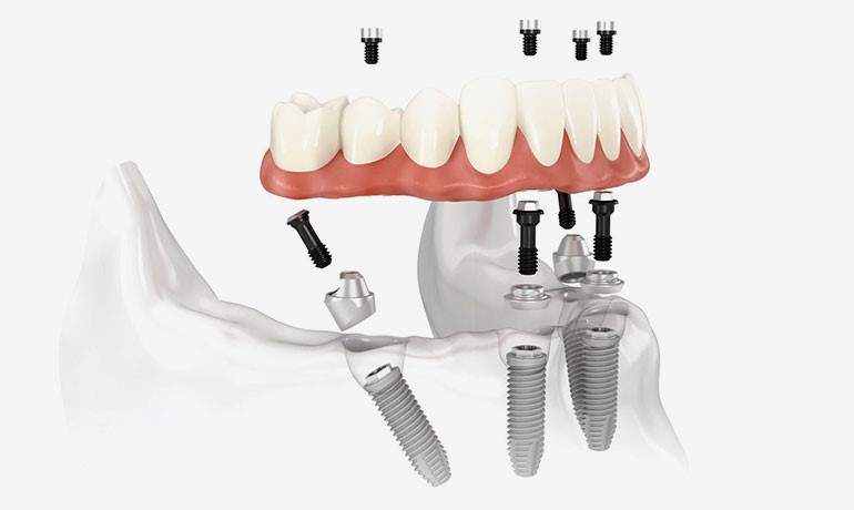 L'implantologia dentale a carico immediato al Centro Odontoiatrico Pitino
