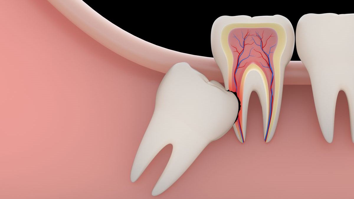Rimuovere il dente del giudizio al Centro Odontoiatrico Pitino
