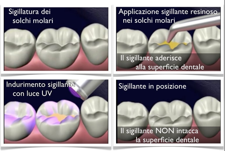 sigillatura denti