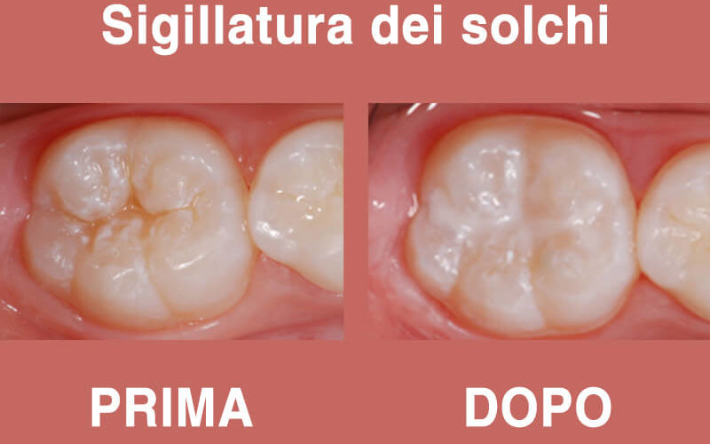 child tooth sealant