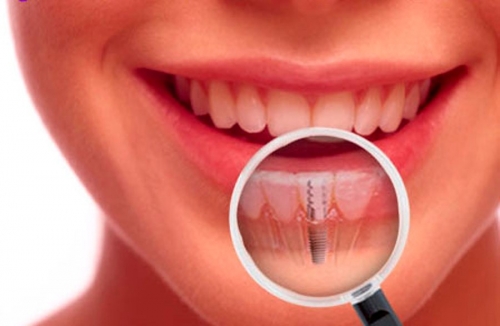 Cosa causa la perdita dei denti e come fare per rimediare