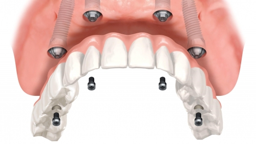 L&#039;implantologia a carico immediato al Centro Odontoiatrico Pitino